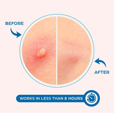 Anti Acne Topical Products