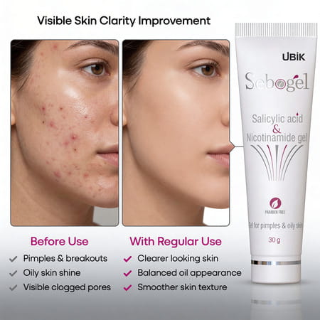 Sebogel Salicylic Acid & Nicotinamide Gel For Pimples And Oily Skin - 30 Gm