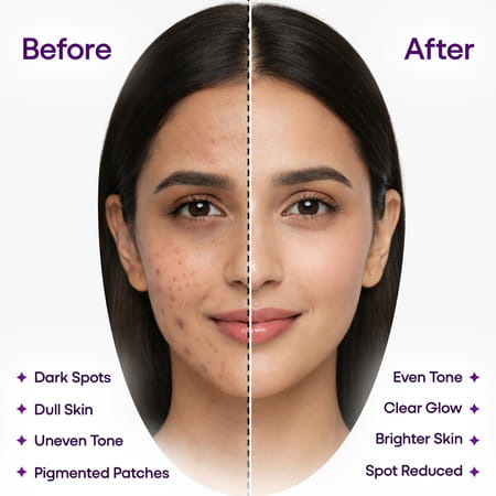 Kozilite H Cream - 20 Gm