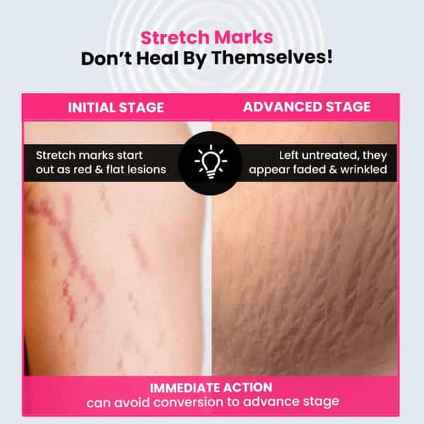 Thriveco Stretch Marks Expert Serum Cream 30Ml