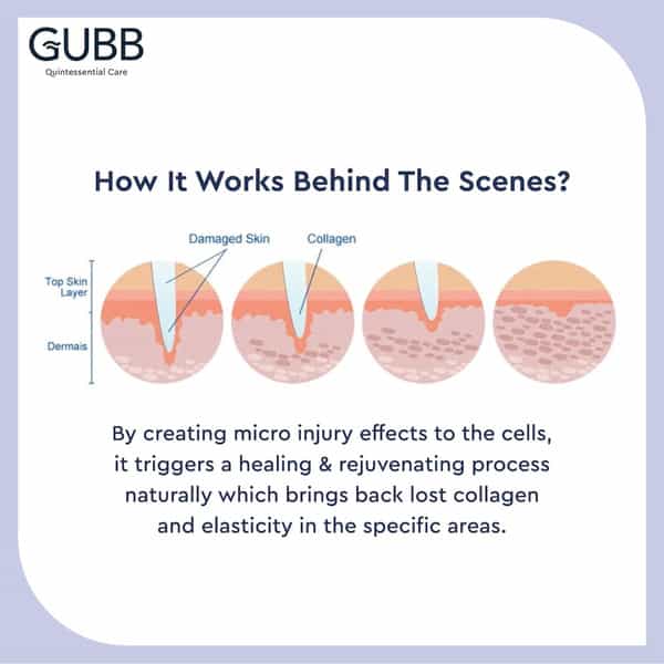 Gubb Derma Roller 0.5Mm For Hair Regrowth Face Acne Scars & Skin Aging 540 Micro Needles - Golden