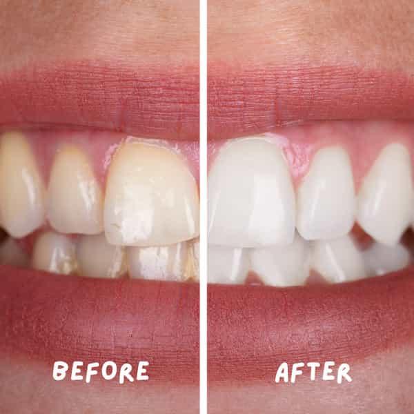 Coco Crush Ayurvedic Teeth Whitening Liquid | 100% Natural - 100Ml