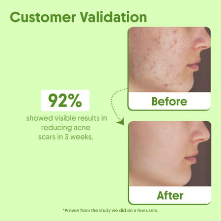 Aravi Organic Tea Tree Essential Oil - Fights Acne | Dandruff & Soothes Scalp - 15ml