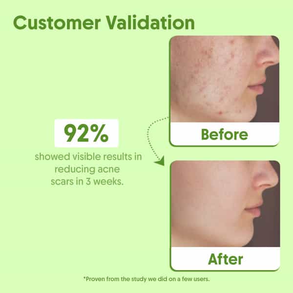 Aravi Organic Tea Tree Essential Oil - Fights Acne | Dandruff & Soothes Scalp - 15Ml