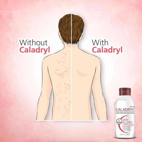 Caladryl Skin Allergy Lotion For Rashes | Sunburn | Prickly Heat And Insect Bites- 125Ml