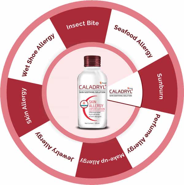 Caladryl Skin Allergy Lotion For Rashes | Sunburn | Prickly Heat And Insect Bites- 125Ml