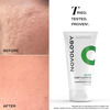 Novology Acne Deep Clearing Cleanser For Acne | Whiteheads | Blackheads Non-Drying (150 G)