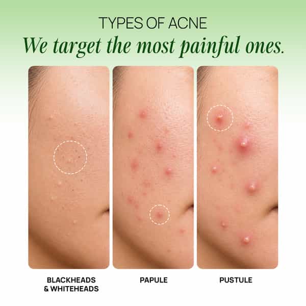 Oziva Acne Care + Milk Thistle | Acne Supplements | Soothes Skin Inflammation (30 X 7 G)