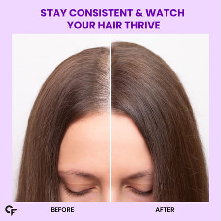 Carbamide Forte Biotin With Sasbania Grandiflora Extract Amla Extract-90 Tablets