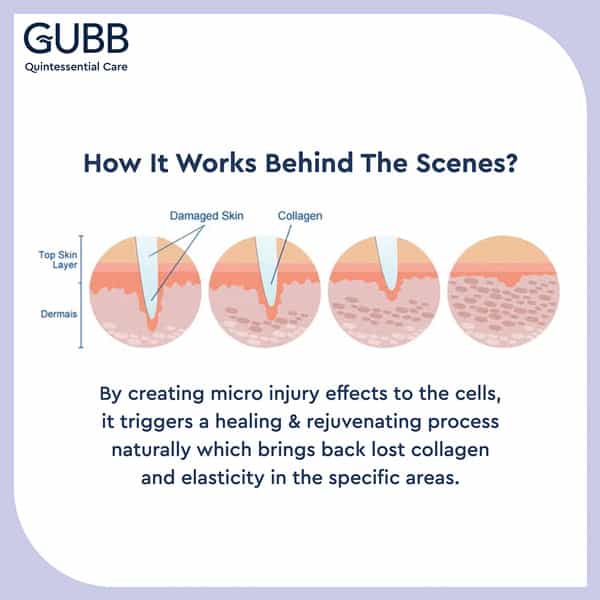 Gubb Derma Roller 0.5Mm For Hair Regrowth Face Acne Scars & Skin Aging 540 Micro Needles - Pink
