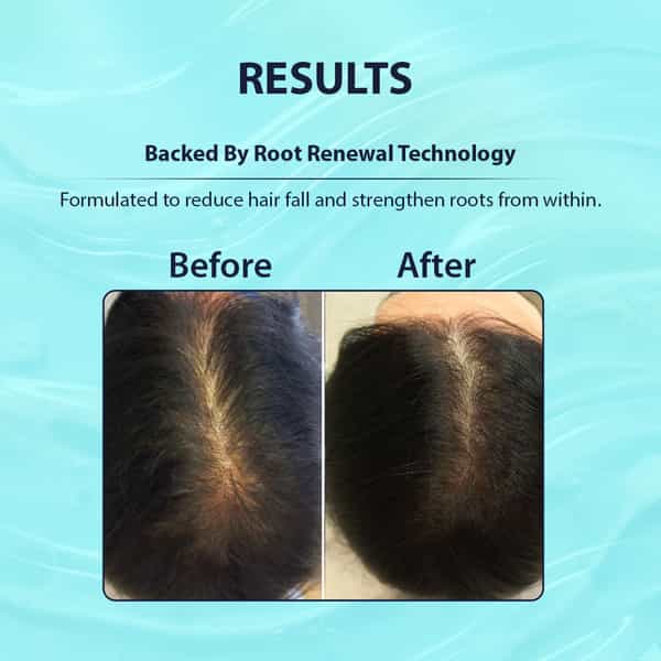Dermistry Anti Hair Fall Control Serum Follicusan Hairgenyl Caffeine For Strengthening Roots 50Ml