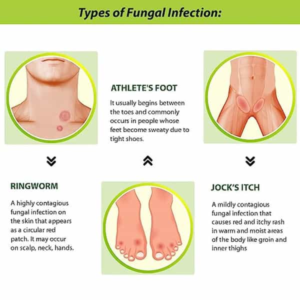Tetmosol Anti-Fungal Dusting Powder -Fights Skin Infections | Heat | Itching - Pack Of 3 (3X100gms)
