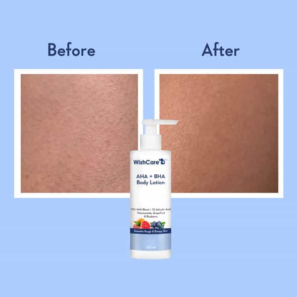 Wishcare 10% Aha + 1% Bha Body Lotion - Smooths Rough & Bumpy Skin - Lactic Acid Body Lotion (200Ml)