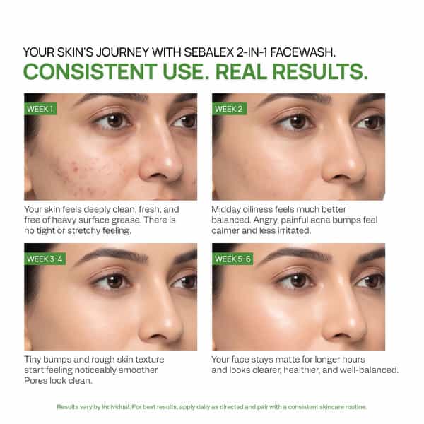Yuderma Sebalex Medi-Acne Face Wash & Mask | 100 Gm