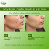 Bake Acne Erase Face Serum With Niacinamide & Azelaic Acid For Pimples | Blackheads & Whiteheads