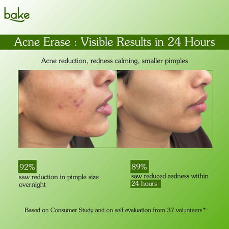 Bake Acne Erase Face Serum With Niacinamide & Azelaic Acid For Pimples | Blackheads & Whiteheads
