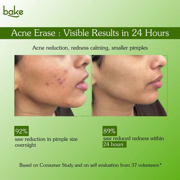 Bake Acne Erase Face Serum With Niacinamide & Azelaic Acid For Pimples | Blackheads & Whiteheads