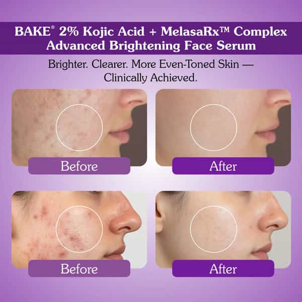 Bake 2% Kojic Acid Face Serum With Melasrx Complex For Dark Spots | Pigmentation (30Ml)