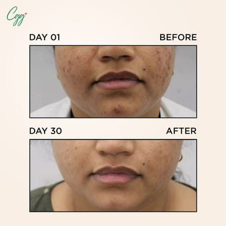 Cgg Cosmetics 70% Snail Mucin Essence( Buy 1 Get1) 0.7 % Cellulose Oil Free- All Skin Types-100Ml