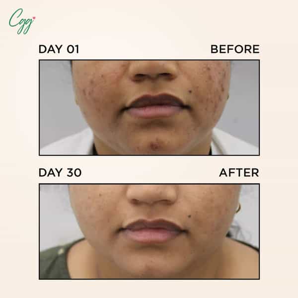 Cgg Cosmetics 70% Snail Mucin Essence( Buy 1 Get1) 0.7 % Cellulose Oil Free- All Skin Types-100Ml