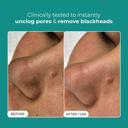 Conscious Chemist Blackhead Melting Water | 50Ml Pore Toner With Glycolic & Succinic Acid