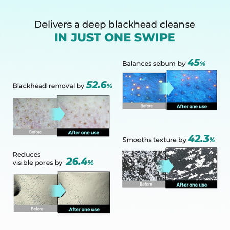 Conscious Chemist Blackhead Melting Water | 50Ml Pore Toner With Glycolic & Succinic Acid