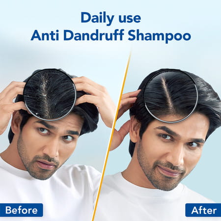 Scalpe Pro Anti-Dandruff Shampoo Bottle Of 400 Ml