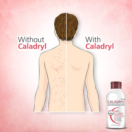 Caladryl Skin Allergy Lotion For Rashes | Sunburn | Prickly Heat And Insect Bites- 125ml (Pack Of 2)