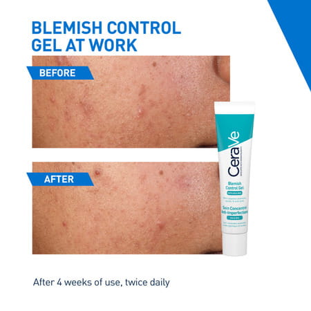 Cerave Blemish Control Gel With 2% Salicylic Acid, Aha & Niacinamide For Acne Spot Treatment 40ml