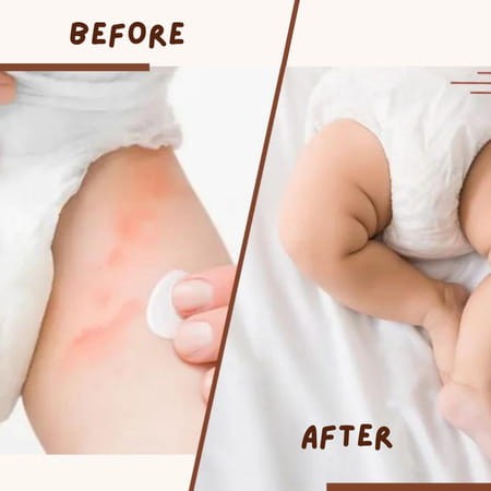 Coco Crush Rash Oil For Babies - Diaper & Nappy Rash Relief | Organic | Prevents Irritation - 200ml