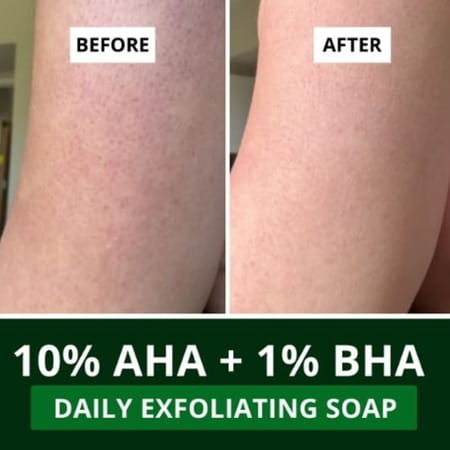 Bake 10% Aha + 1% Bha Soap For Pores | Exfoliation & Strawberry Skin (Pack Of 3)