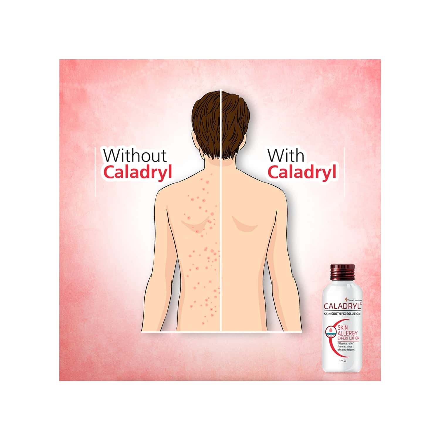 Buy CALADRYL SKIN ALLERGY EXPERT CALAMINE LOTION SKIN SOOTHING