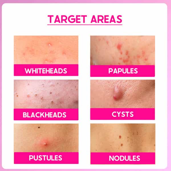 Cos-Iq Abp 33% Strong Exfoliating Peel Aha 25% | Pha 6% | Bha 2% Peeling Solution