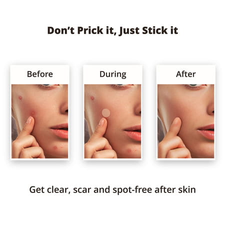Bbold Dissolvable Microneedle Acne Patch - Pack Of 1
