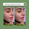 Azah Microneedle Acne Patch For Quick Acne | Scarring | & Blemish Treatment|9 Patches (10 Ml)
