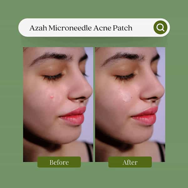Azah Microneedle Acne Patch For Quick Acne | Scarring | & Blemish Treatment|9 Patches (10 Ml)