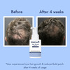 Wishcare Hair Growth Serum Concentrate - Redensyl|Anagain|Caffeine|Biotin|Keratin|Rice Water - 20Ml