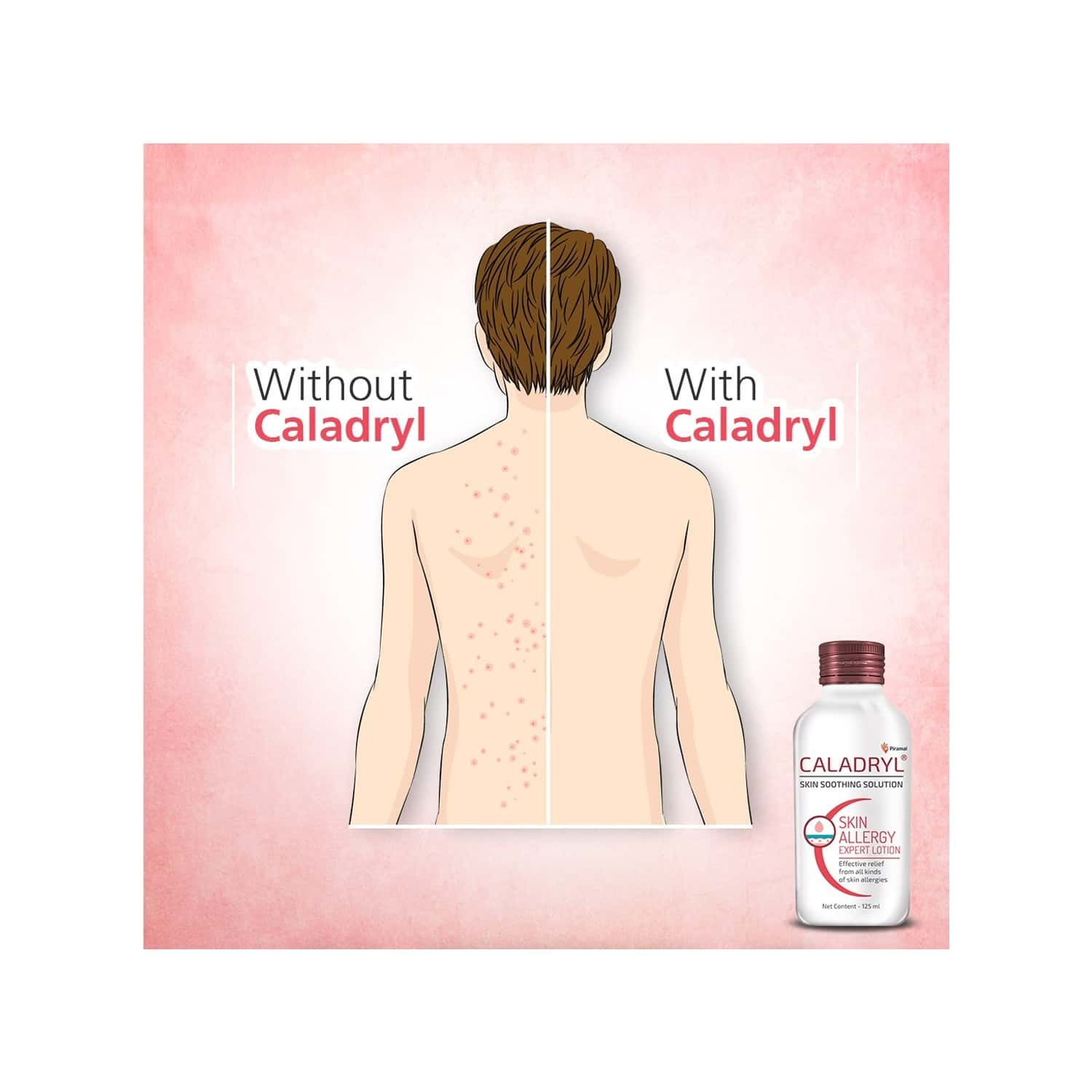 Buy CALADRYL SKIN ALLERGY LOTION FOR ALL SKIN TYPES 65ML Online & Get