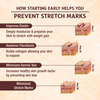 Anti Stretch Marks Herbal Cream | Scar Removal | During & After Pregnancy | 100% Ayurvedic | 50G