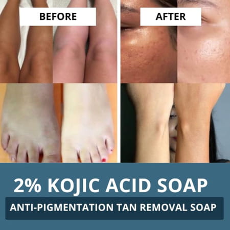 Bake 2% Kojic Soap With Arbutin | Lactic Acid & Niacinamide For Dark Spots (Pack Of 1)