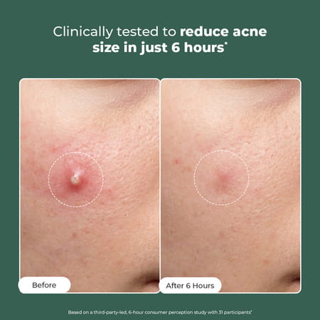 Conscious Chemist Rapid Relief Acne Spot Gel | 2% Salicylic & Azelaic Acid | 15G