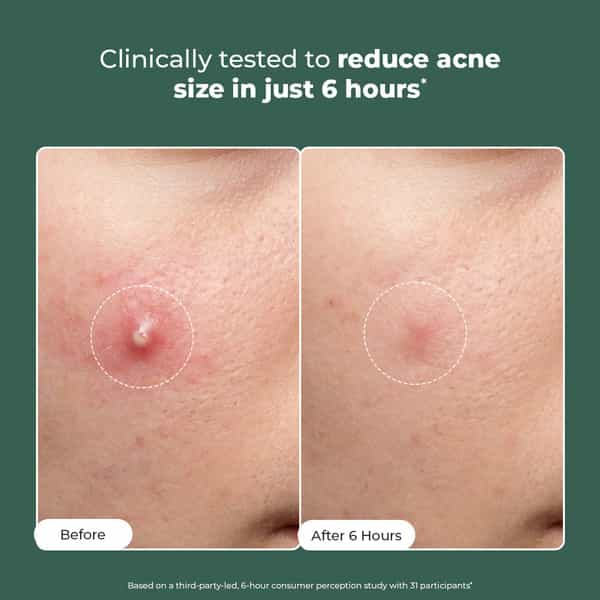Conscious Chemist Rapid Relief Acne Spot Gel | 2% Salicylic & Azelaic Acid | 15G
