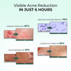 Conscious Chemist Rapid Relief Acne Spot Gel | 2% Salicylic & Azelaic Acid | 15G