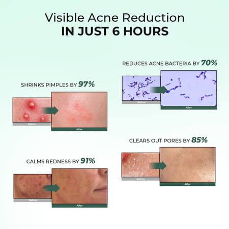Conscious Chemist Rapid Relief Acne Spot Gel | 2% Salicylic & Azelaic Acid | 15G