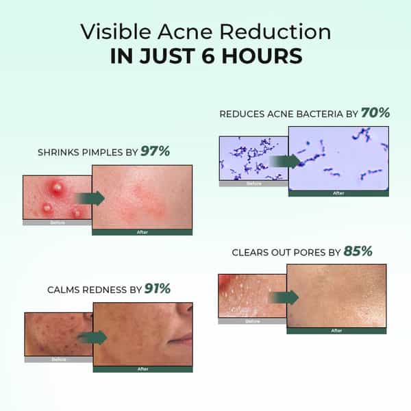 Conscious Chemist Rapid Relief Acne Spot Gel | 2% Salicylic & Azelaic Acid | 15G