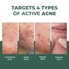 Conscious Chemist Rapid Relief Acne Spot Gel | 2% Salicylic & Azelaic Acid | 15G