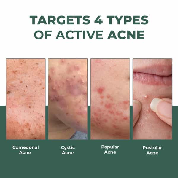 Conscious Chemist Rapid Relief Acne Spot Gel | 2% Salicylic & Azelaic Acid | 15G
