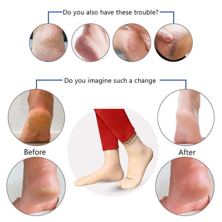 Dr Foot Silicone Socks | Anti Slip Silicone Moisturizing Socks | Dry Cracking Skin | Size L - 1 Pair