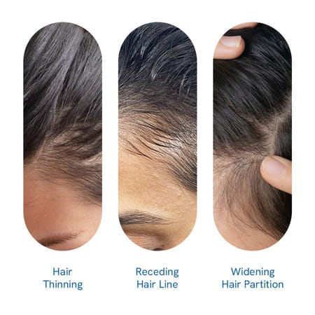 Be Bodywise Hair Growth Serum Roll On | Reduces Hairfall & Thinning | No Added Sugar | 25 Ml