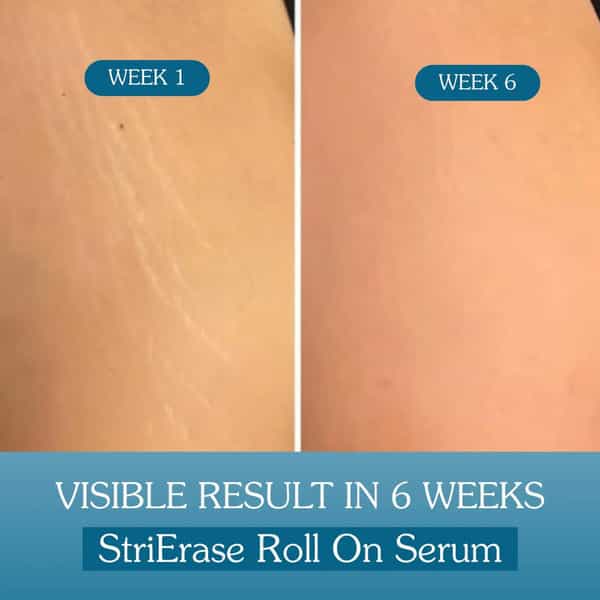 Bake Strierase Stretch Marks Removal Roll-On Serum For Fades Stretch Marks & Scars (50Ml)